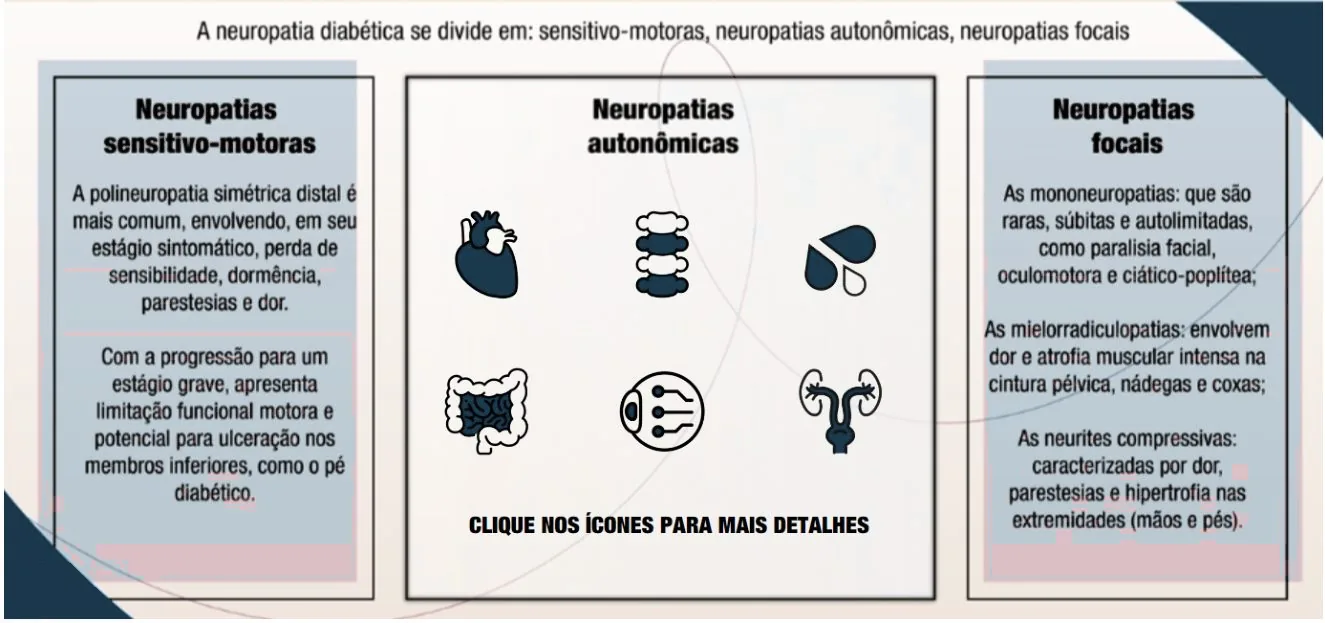 Infográfico: a neuropatia diabética se divide em sensitivo-motoras, neuropatias autonômicas e neuropatias focais. Neuropatias sensitivo-motoras: a polineuropatia simétrica distal é mais comum, envolvendo, em seu estágio sintomático, perda de sensibilidade, dormência, parestesias e dor; com a progressão para um estágio grave, apresenta limitação funcional motora e potencial para ulceração nos membros inferiores, como o pé diabético. Neuropatias autonômicas: seis ícones (coração, coluna vertebral, gotas, intestino, olho, sistema geniturinário) com a indicação "Clique nos ícones para mais detalhes". Neuropatias focais: as mononeuropatias, que são raras, súbitas e autolimitadas, como paralisia facial, oculomotora e ciático-poplítea; as mielorradiculopatias, que envolvem dor e atrofia muscular intensa na cintura pélvica, nádegas e coxas; as neurites compressivas, caracterizadas por dor, parestesias e hipertrofia nas extremidades (mãos e pés).