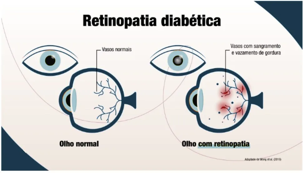 Ilustração "Retinopatia diabética" comparando dois olhos em corte: à esquerda, o olho normal, com vasos normais na retina; à direita, o olho com retinopatia, com vasos com sangramento e vazamento de gordura (manchas vermelhas na retina).
